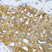 Immunohistochemistry of paraffin-embedded Human breast cancer using ATG7 Antibody (1/100 dilution, 40x lens).