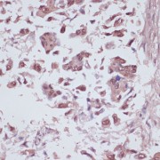 Immunohistochemistry of paraffin-embedded Human lung cancer using U2AF1 Antibody (1/100 dilution, 40x lens).