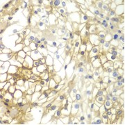 Immunohistochemistry of paraffin-embedded Human kidney cancer using Syndecan-1 Antibody (1/200 dilution, 40x lens).