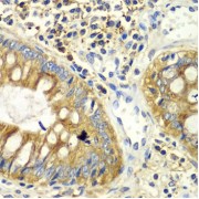 Immunohistochemistry of paraffin-embedded human colon using PICK1 Antibody (1/100 dilution, 40x lens). Microwave antigen retrieval was performed in 10 mM PBS buffer pH 7.2 before commencing with IHC staining protocol.
