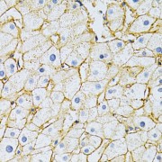 Immunohistochemistry of paraffin-embedded Human liver damage using BSG Antibody (1/200 dilution, 40x lens).