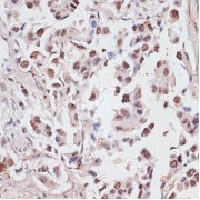 Immunohistochemistry of paraffin-embedded Human lung cancer using DKC1 Antibody (1/100 dilution, 40x lens).