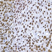 Immunohistochemistry of paraffin-embedded human esophageal cancer using HIST1H1C Antibody (1/200 dilution, 40x lens). High pressure antigen retrieval was performed in 10 mM citrate buffer pH 6.0 before commencing with IHC staining protocol.