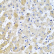 Immunohistochemistry of paraffin-embedded Human liver damage using EIF3M Antibody (1/100 dilution, 40x lens).