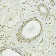 Immunohistochemistry of paraffin-embedded Human breast using Snail Antibody (1/100 dilution, 40x lens).