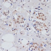 Immunohistochemistry of paraffin-embedded Human breast cancer using SKIV2L2 Antibody (1/100 dilution, 40x lens).