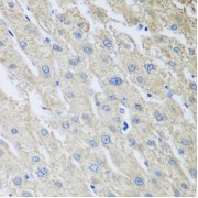 Immunohistochemistry of paraffin-embedded Human liver cancer using MLKL Antibody (1/100 dilution, 40x lens).