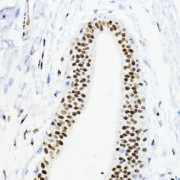 Immunohistochemistry of paraffin-embedded Human mammary cancer using ZEB1 Antibody (1/200 dilution, 40x lens).