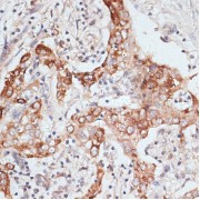 Immunohistochemistry of paraffin-embedded Human liver cancer using PIGR Antibody (1/100 dilution, 40x lens).