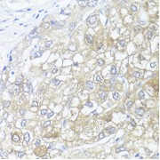 Immunohistochemistry of paraffin-embedded Human liver cancer using ASL Antibody (1/100 dilution, 40x lens).