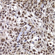 Immunohistochemistry of paraffin-embedded Human well-differentiated squamous skin carcinoma using DNAJB6 Antibody (1/100 dilution, 40x lens).