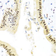 Immunohistochemistry of paraffin-embedded Human liver damage using ZBTB17 Antibody (1/100 dilution, 40x lens).
