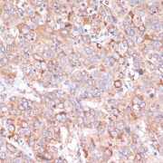 Immunohistochemistry of paraffin-embedded Human liver cancer using YAP1 Antibody (1/100 dilution, 40x lens).