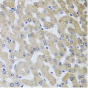 Immunohistochemistry of paraffin-embedded Human liver damage using UVRAG Antibody (1/100 dilution, 40x lens).