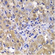 Immunohistochemistry of paraffin-embedded Human liver damage using CARD10 Antibody (1/100 dilution, 40x lens).