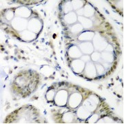 Immunohistochemistry of paraffin-embedded Human colon carcinoma using CDC27 Antibody (1/200 dilution, 40x lens).