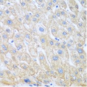 Immunohistochemistry of paraffin-embedded Human liver cancer using PTGS1 Antibody (1/100 dilution, 40x lens).