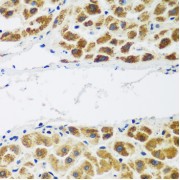 Immunohistochemistry of paraffin-embedded Human liver cancer using NAA60 Antibody (1/200 dilution, 40x lens).