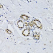 Immunohistochemistry of paraffin-embedded Human breast using BCCIP Antibody (1/100 dilution, 40x lens).