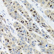 Immunohistochemistry of paraffin-embedded Human esophageal cancer using Ki67 Antibody (1/100 dilution, 40x lens). Microwave antigen retrieval was performed in 10 mM Tris/EDTA buffer pH 9.0 before commencing with IHC staining protocol.