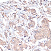 Immunohistochemistry of paraffin-embedded Human breast cancer using PRMT7 Antibody (1/200 dilution, 40x lens).