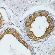 Immunohistochemistry of paraffin-embedded Human mammary cancer using WNT1 Antibody (1/100 dilution, 40x lens).
