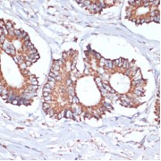 Immunohistochemistry of paraffin-embedded Human colon carcinoma using UBE2O Antibody (1/100 dilution, 40x lens).