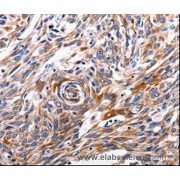IHC-P analysis of Human esophagus cancer tissue, using ACE2 antibody (1/200 dilution).